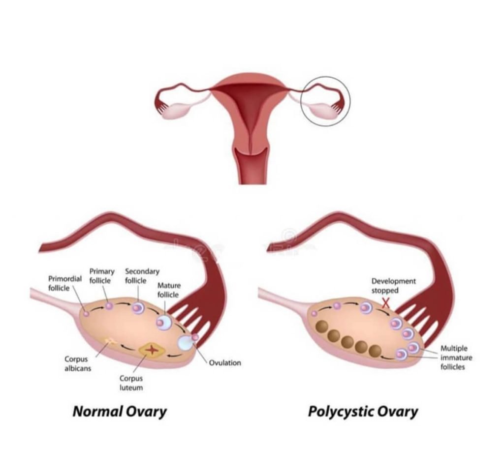 PCOS Advocacy Day 2023 graphic showing normal ovary and polycystic ovary